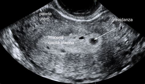 Ecografia di un embrione nell'utero