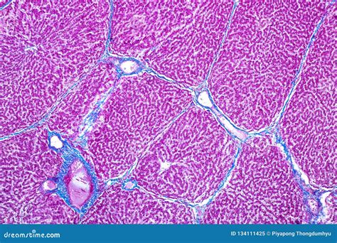 Microscopio di un fegato con cirrosi