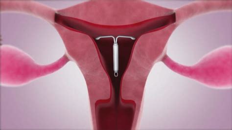 Tipi di spirale intrauterina