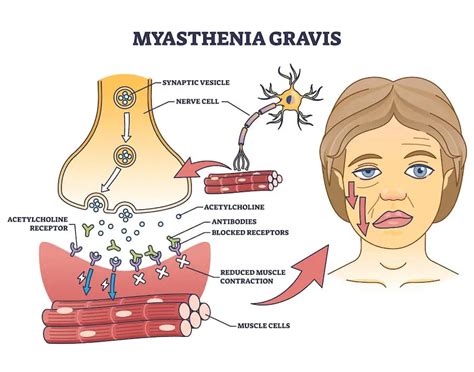 Diagramma che illustra il blocco della comunicazione neuromuscolare nella miastenia gravis