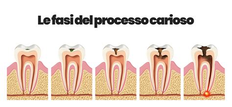 Schema della carie dentale