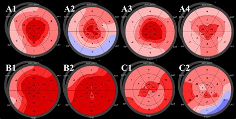 Immagine che confronta il pattern di strain nell'amiloidosi cardiaca (apical sparing) e in altre cardiomiopatie