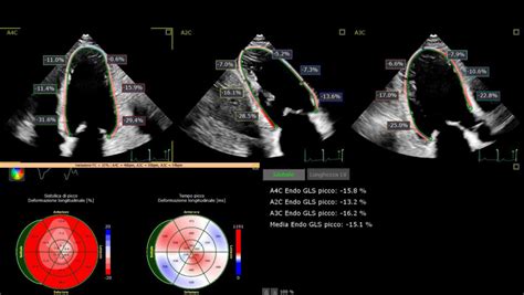Immagine ecocardiografica che mostra l'applicazione dello speckle tracking al ventricolo destro