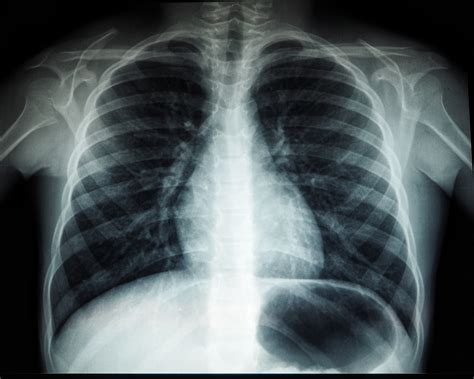 Esempio di radiografia toracica che mostra addensamenti polmonari
